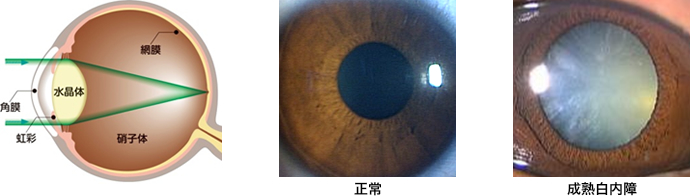 白内障は目の中のレンズ（水晶体）が白く濁る病気です。