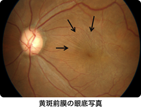 黄斑前膜の眼底写真