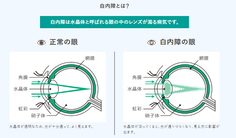 白内障とは？