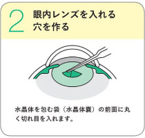 2.眼内レンズを入れる穴を作る