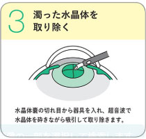 3.濁った水晶体を取り除く