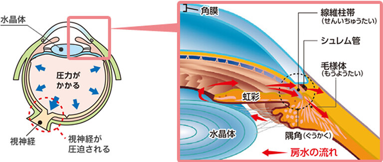 緑内障手術