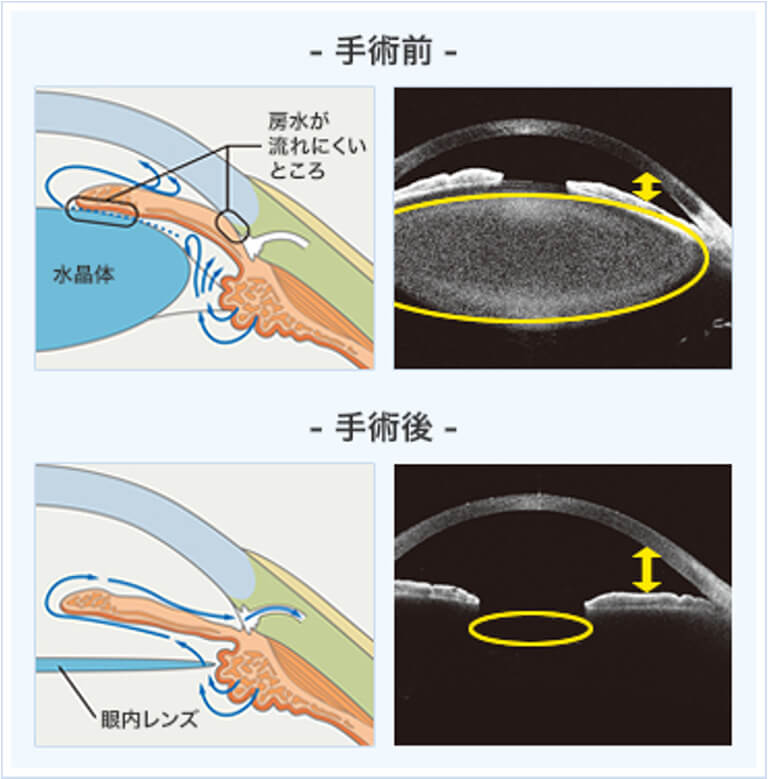 レンゼクトミー