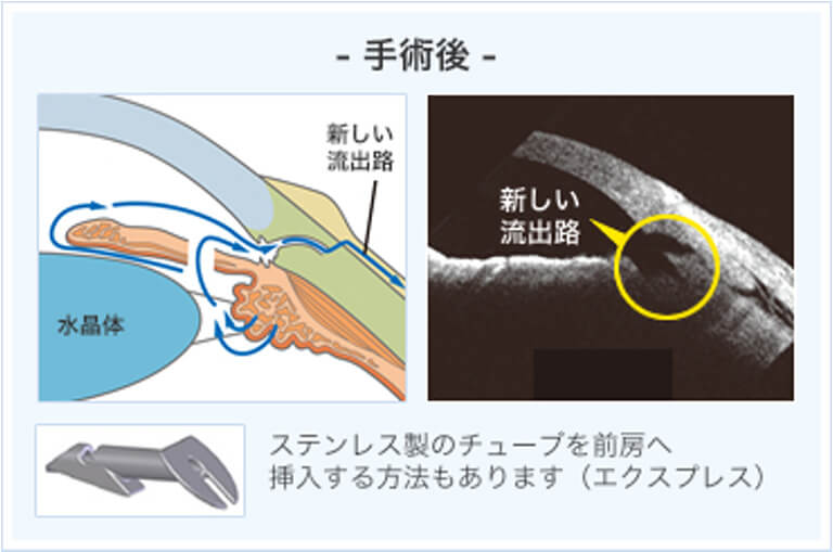 濾過手術