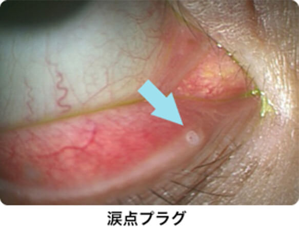 シェーングレン症候群