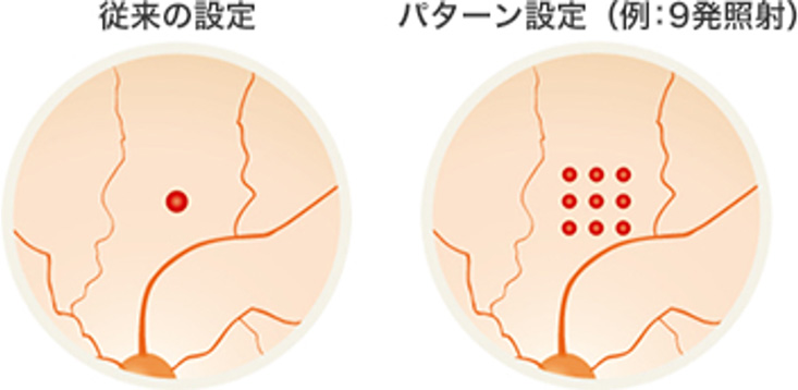 パターン照射