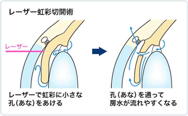 レーザー虹彩切開術