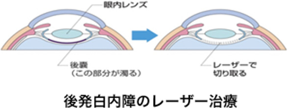 後発白内障のレーザー治療