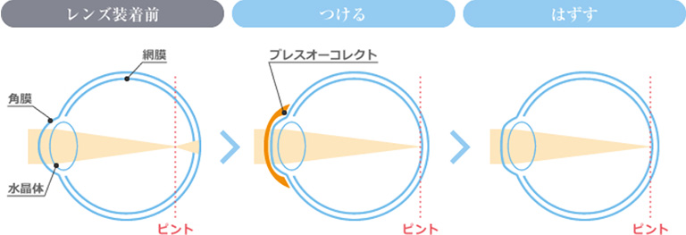 オルソケラトロジーの仕組み