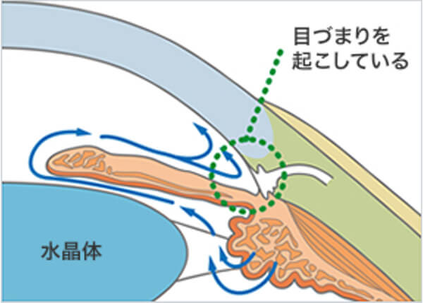 開放隅角緑内障