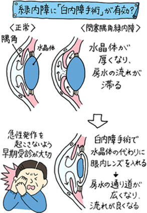 緑内障に白内障手術が有効？