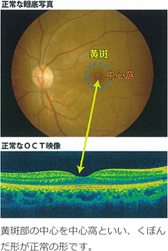 黄斑とは？