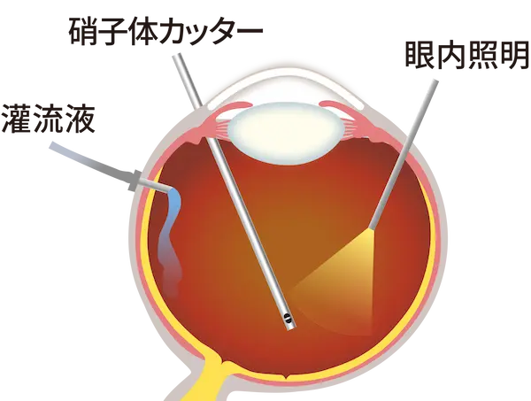 日帰り硝子体手術
